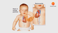 dextrocardia